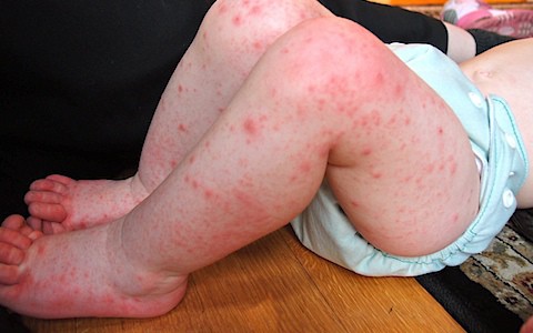Pictures and Symptoms of Hand Foot and Mouth Disease